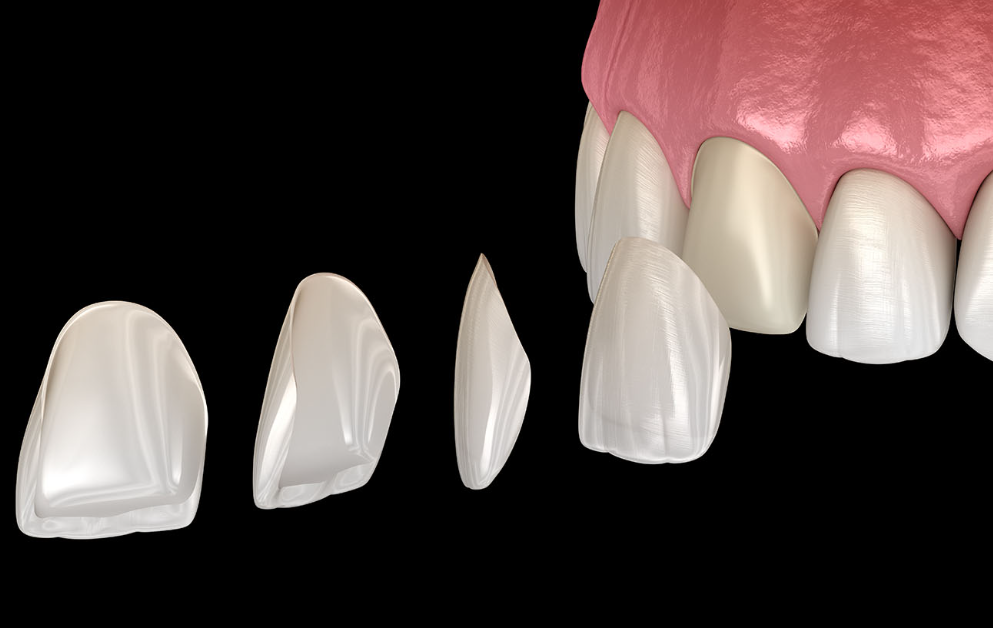 porcelain veneers in Sydney